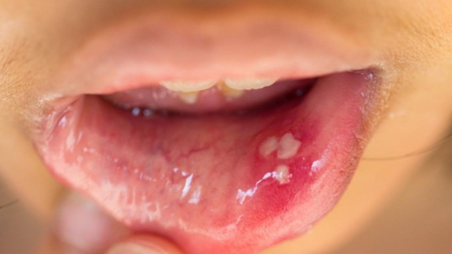 Nhiễm HPV ở miệng: Nguyên nhân và cách phòng ngừa bệnh hiệu quả - Nhà thuốc FPT Long Châu